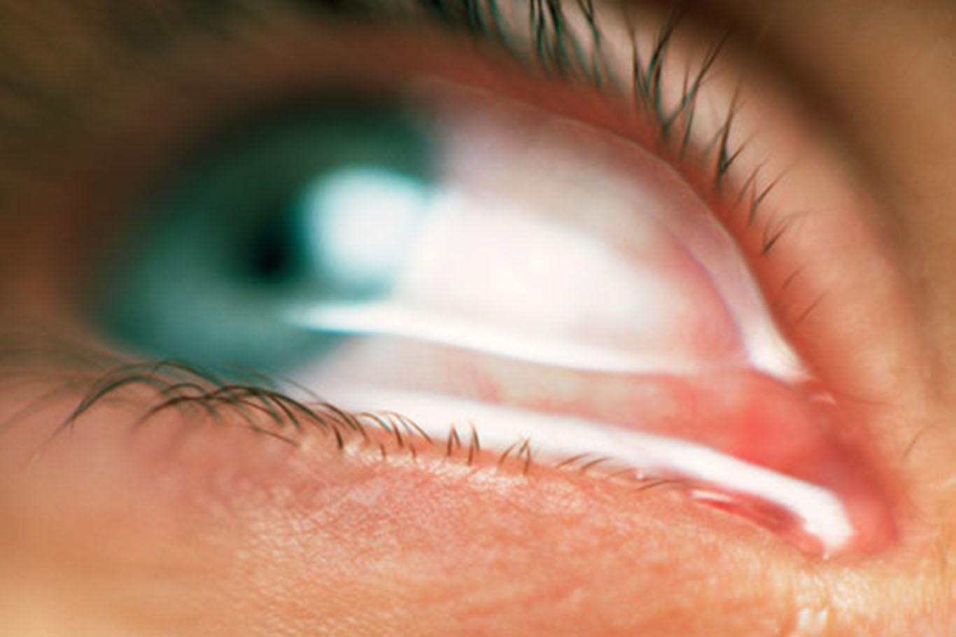 What causes mucus strands in the eyes?